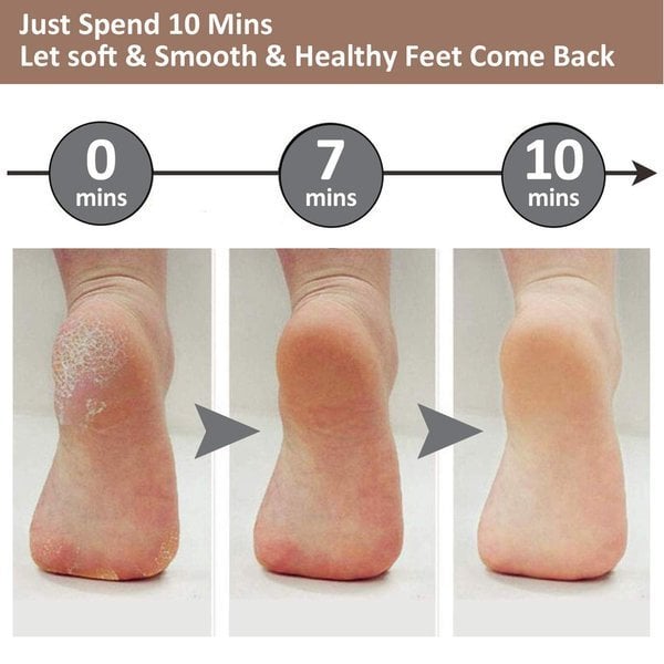 🔥Rechargeable Electric Foot Callus Remove🎁Get Free moisturizer