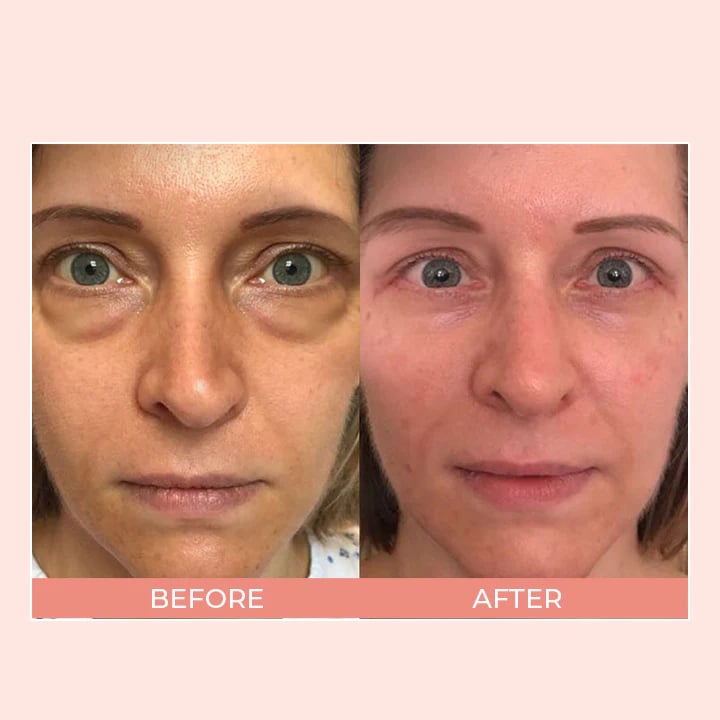 Retinol Eye Cream Stickš„š„BUY 2 GET 1 FREE