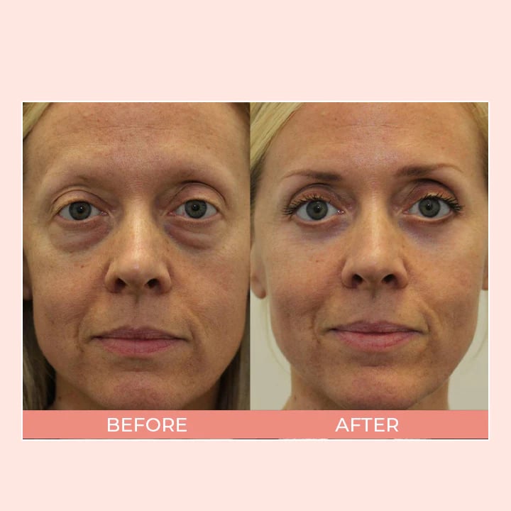 Retinol Eye Cream Stickš„š„BUY 2 GET 1 FREE
